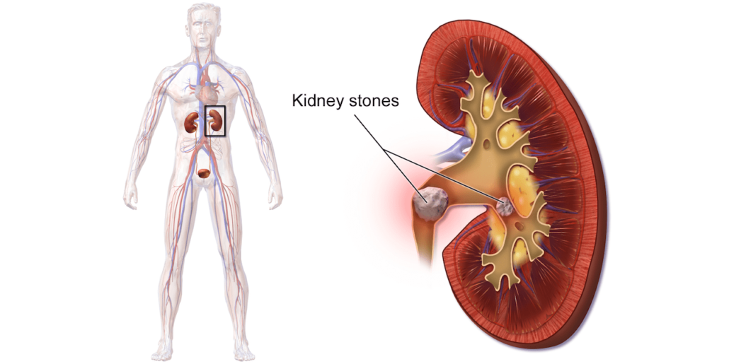 kidney stone