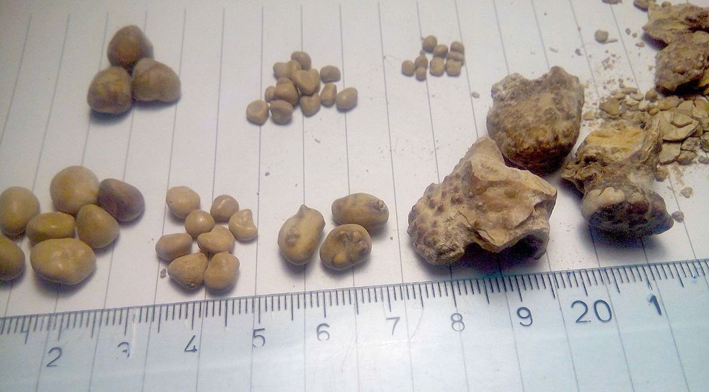 kidney stones size