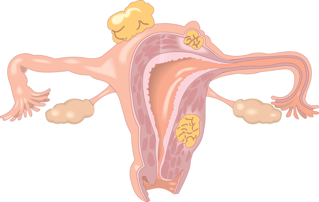 polycystic ovarian syndrome