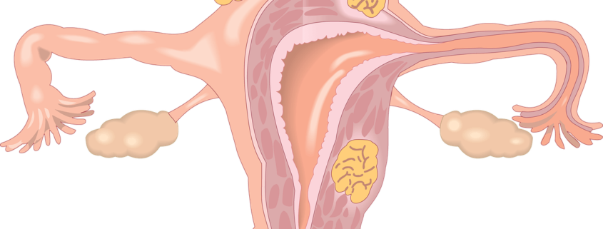 polycystic ovarian syndrome