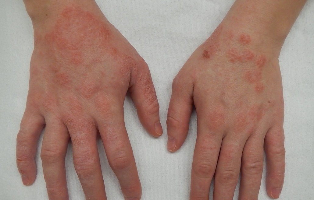 eczema remedies