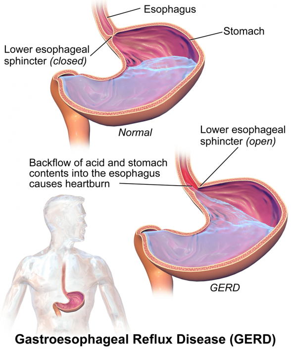 GERD (Gastroesophageal Reflux Disease) Ayurveda Benefits, Ayurvedic